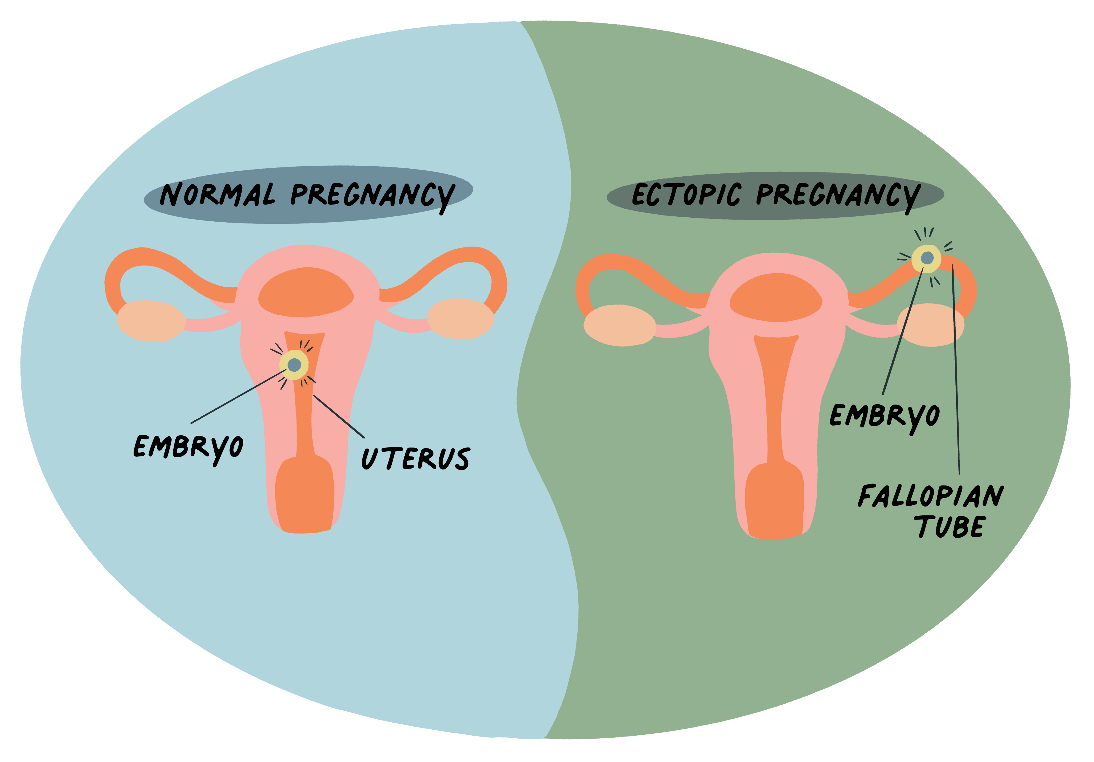 Ectopic Pregnancy Agape Women s Services